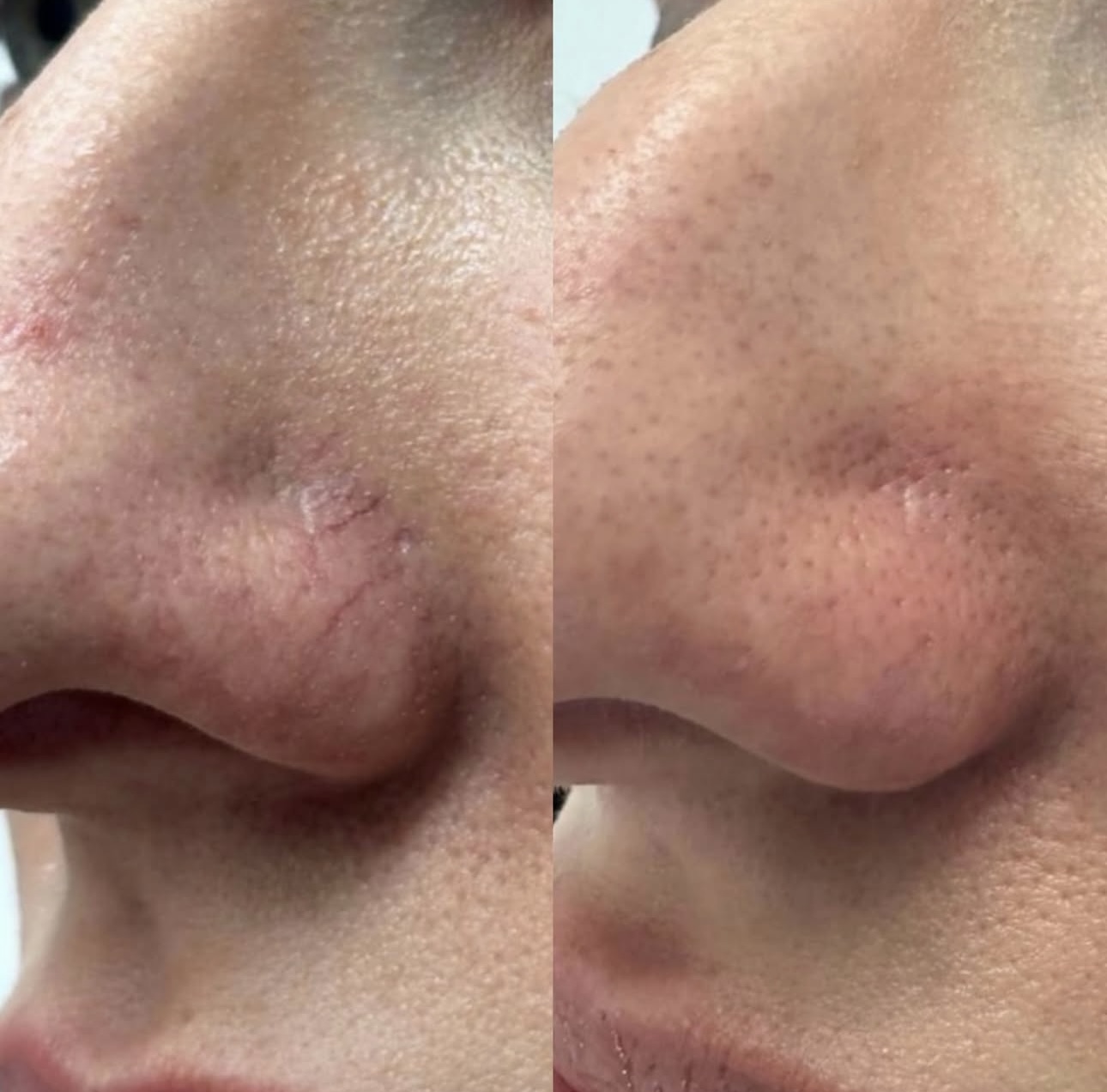 Lumecca before and after 3