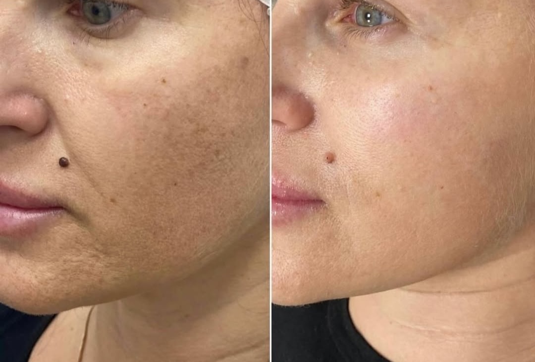 Lumecca before and after 2