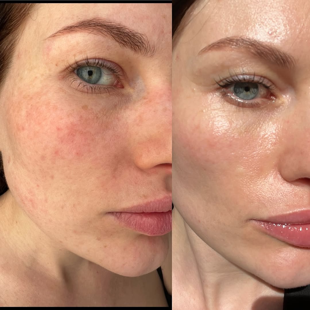 Lumecca before and after 1