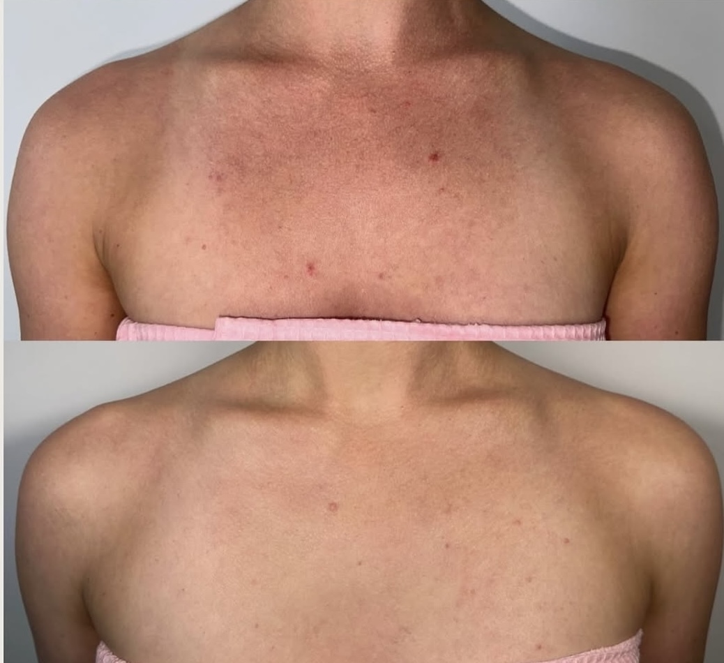 Lumecca before and after 4