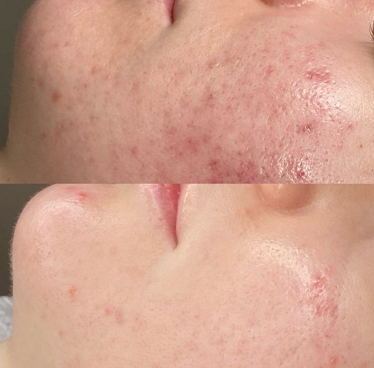 Microneedling before and after 4