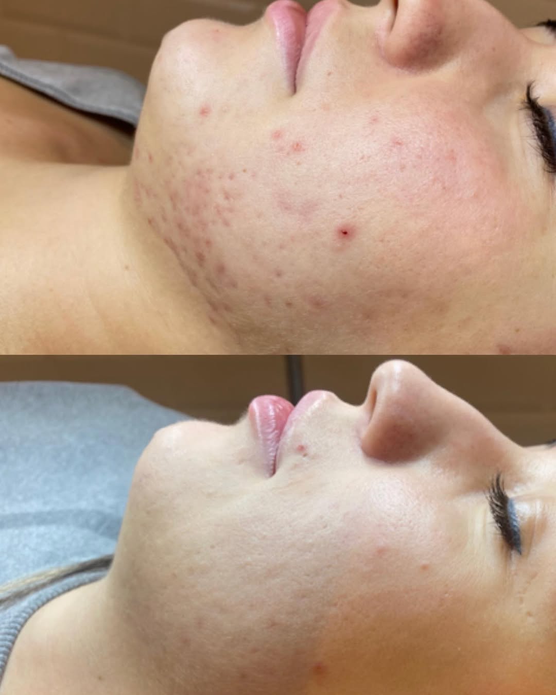 Microneedling before and after 3
