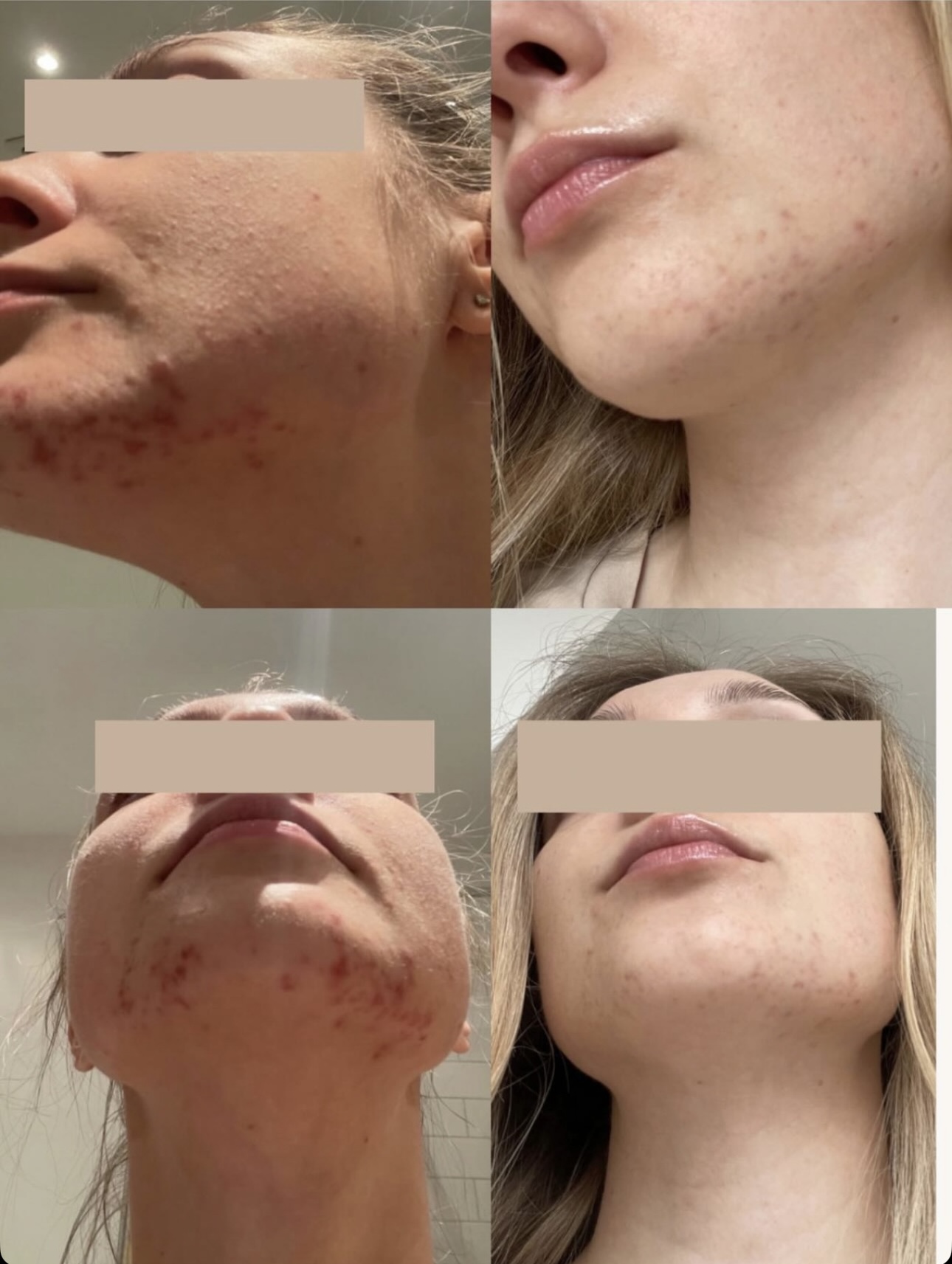 Microneedling before and after 2