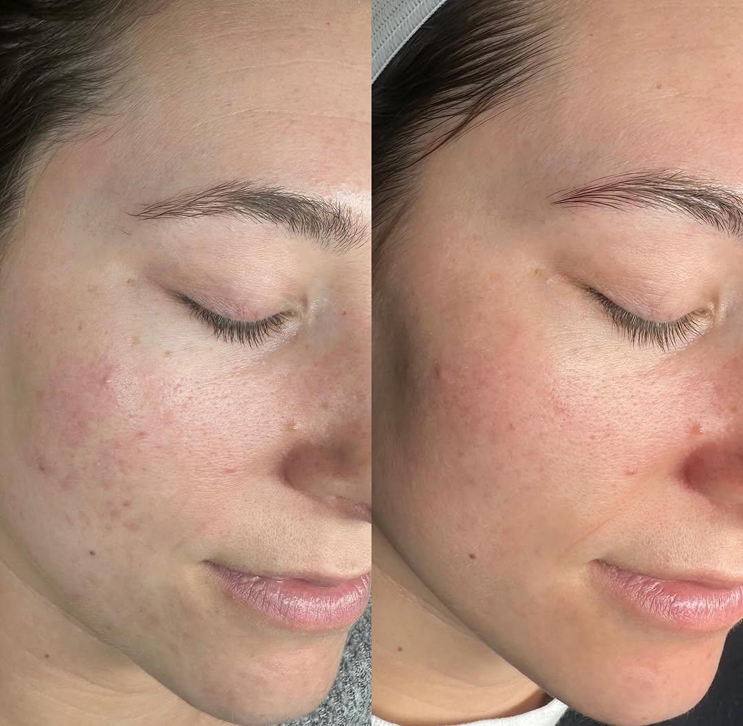 Microneedling before and after 1
