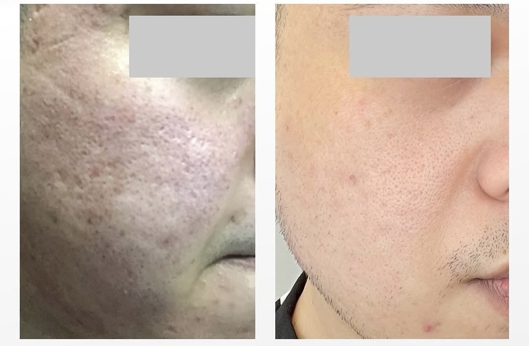 Morpheus8 before and after 4