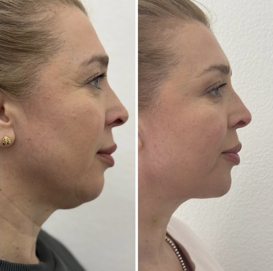 Morpheus8 before and after 3