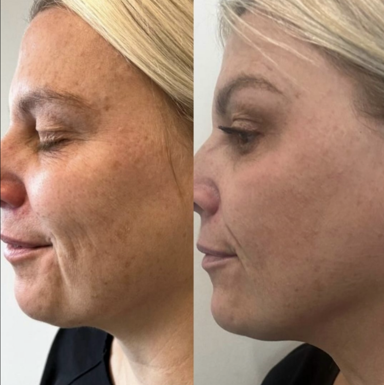 Morpheus8 before and after 2