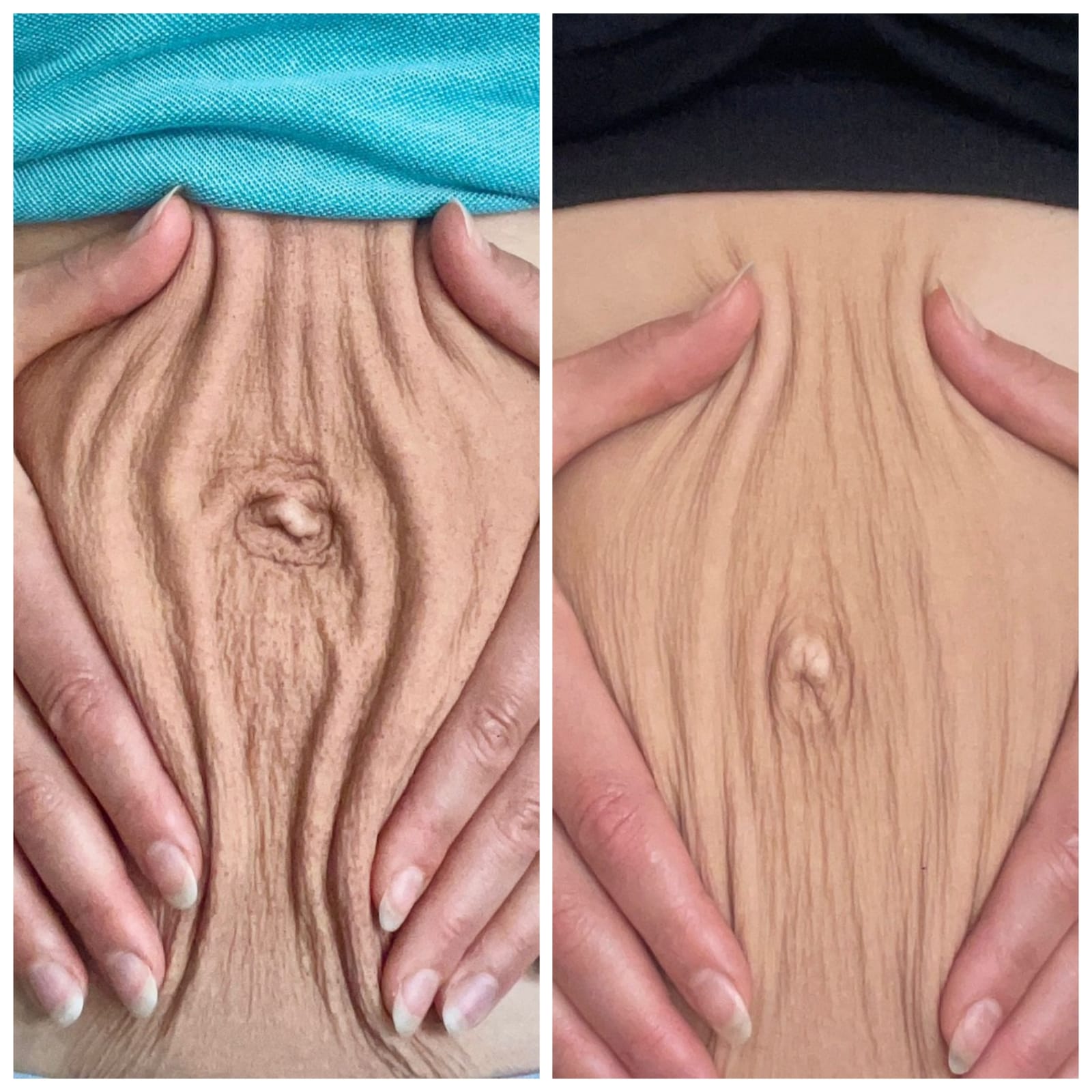 Morpheus8 before and after 5