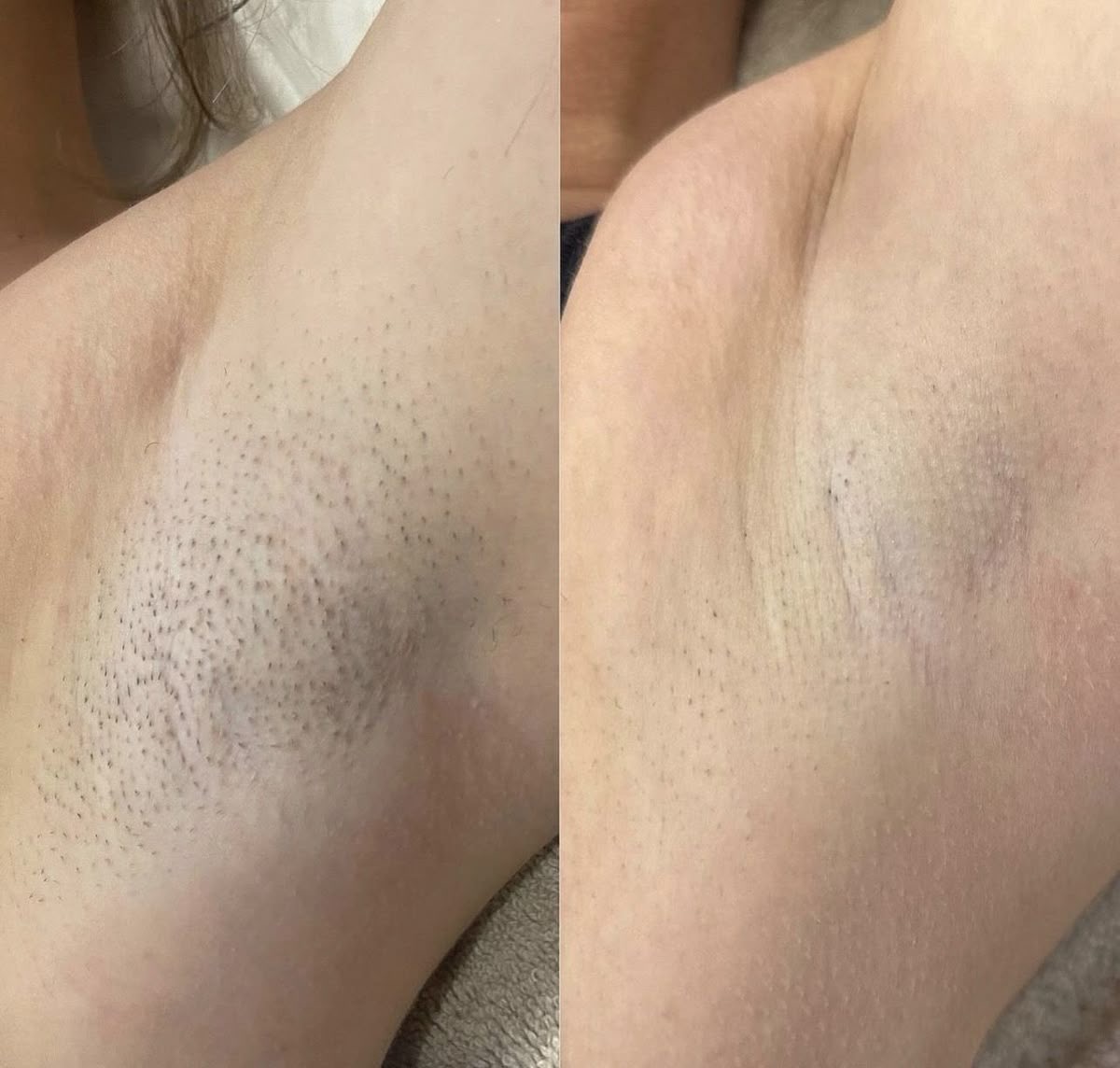 Laser hair removal before and after 3