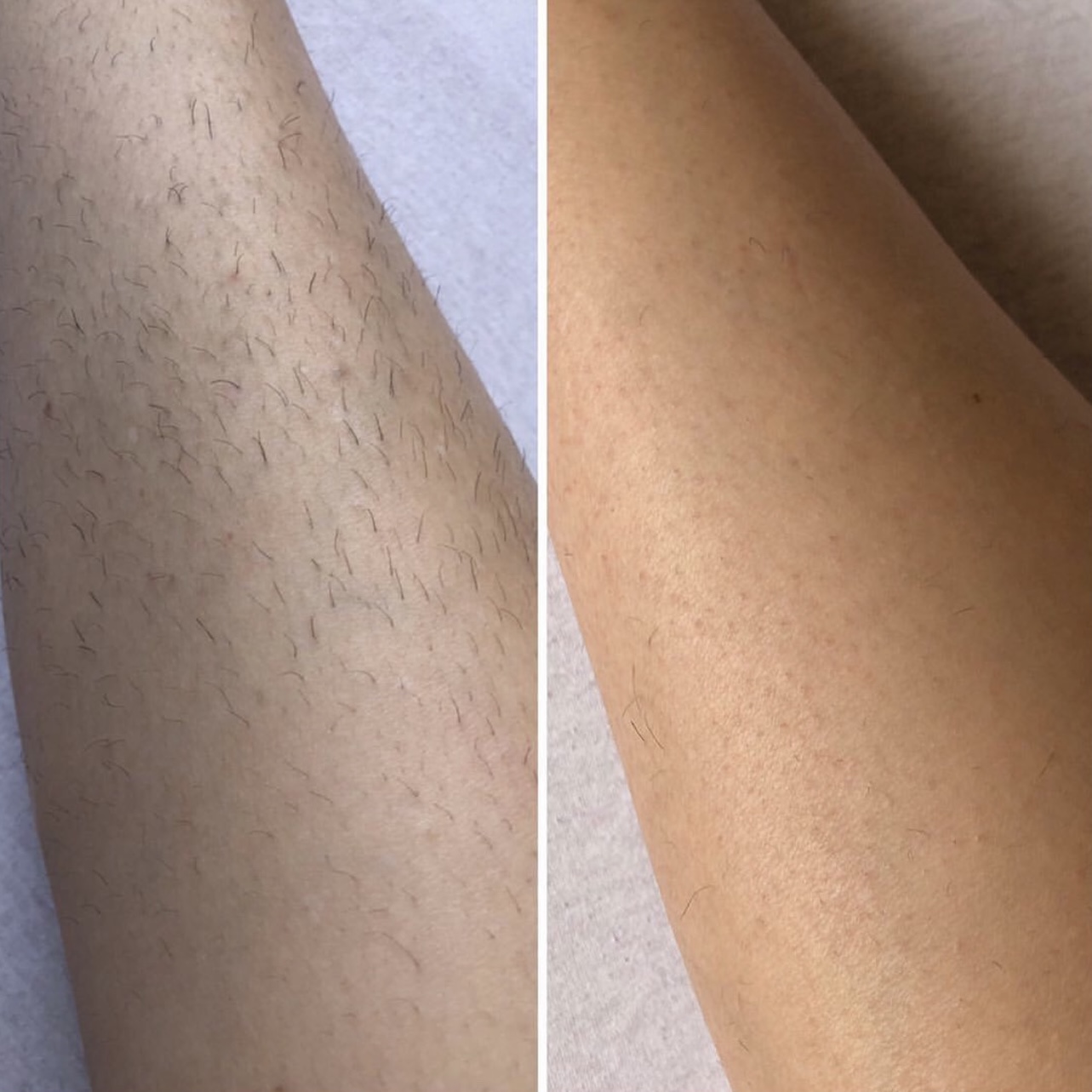 Laser hair removal before and after 2