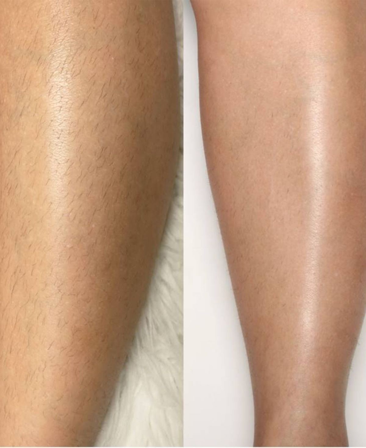 Laser hair removal before and after 1