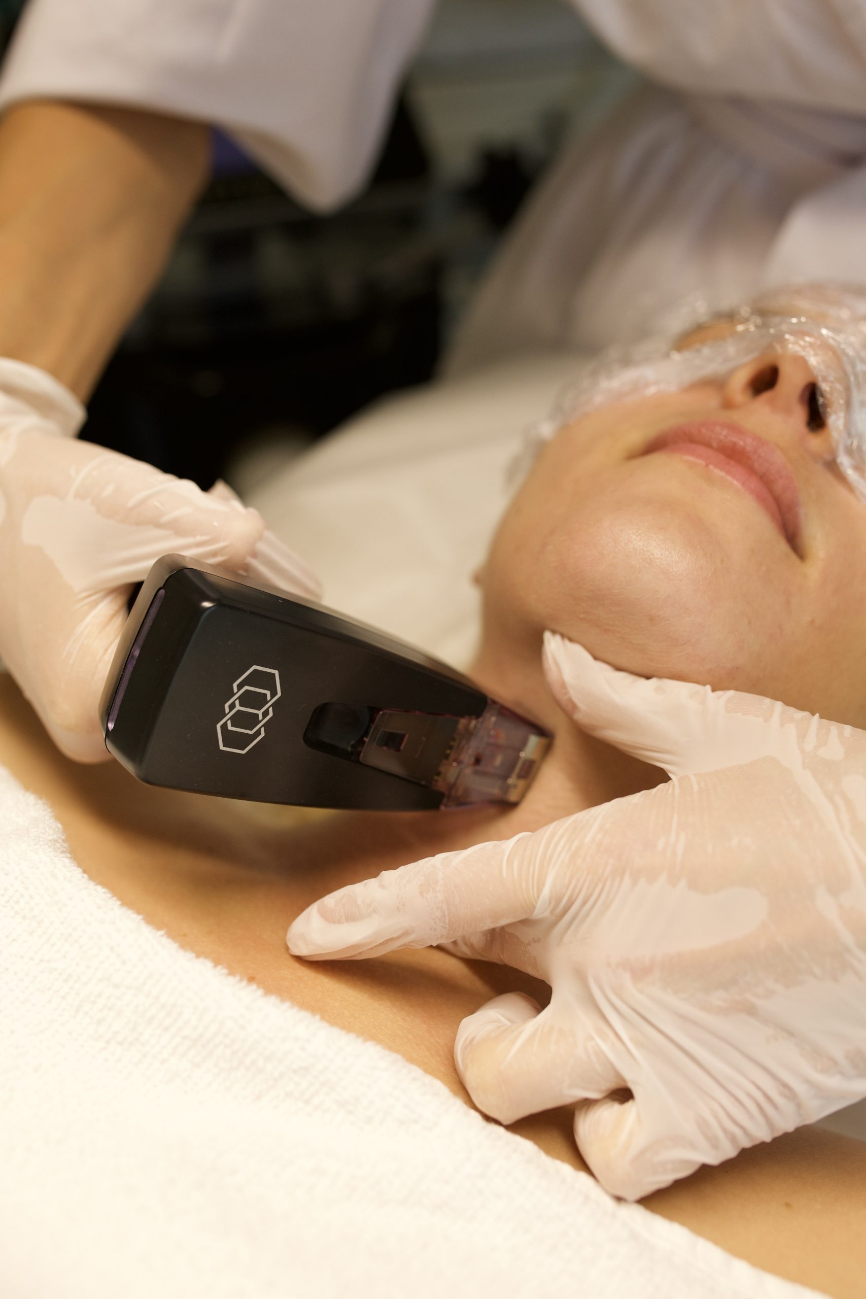 Morpheus8 RF microneedling treatment at Skin Gallery Amsterdam