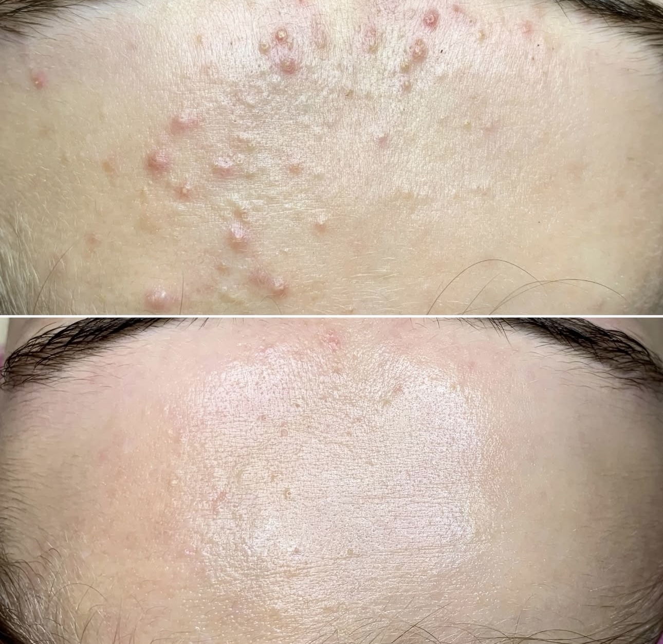 Acne before and after 3