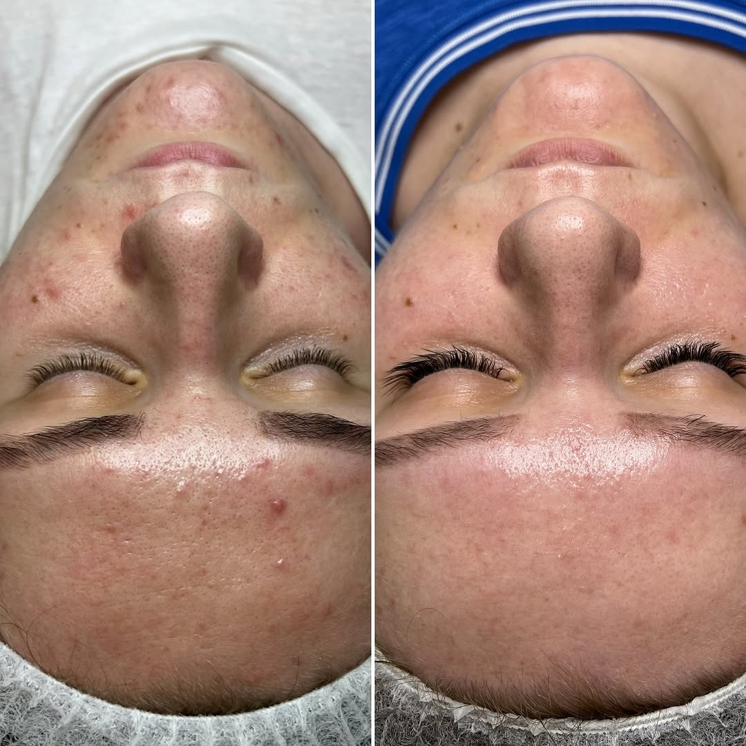Acne before and after 2