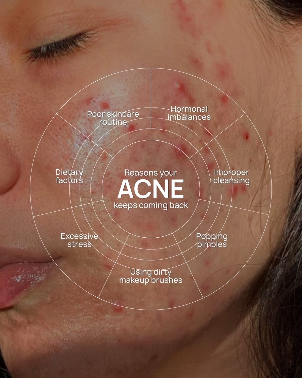 Skin Gallery acne consultation and treatment