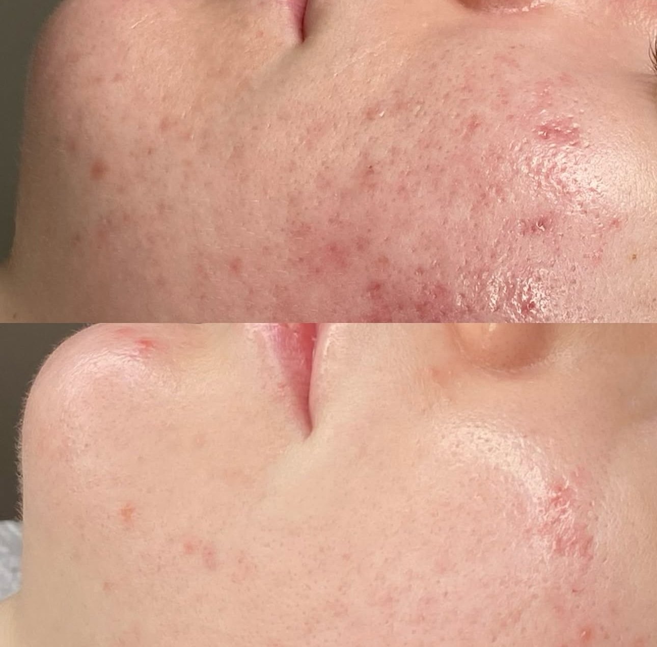 Microneedling voor en na 4