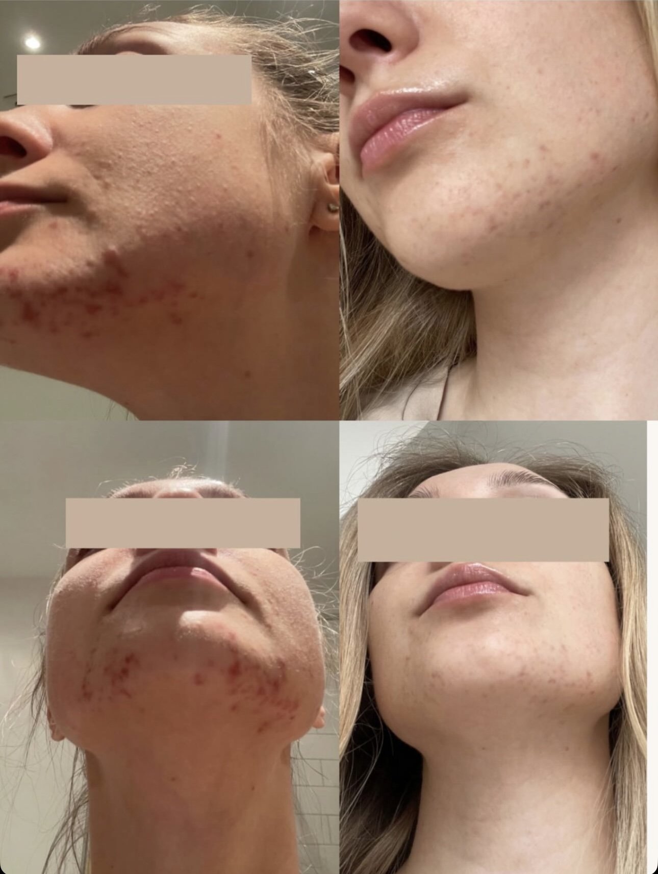 Microneedling voor en na 2