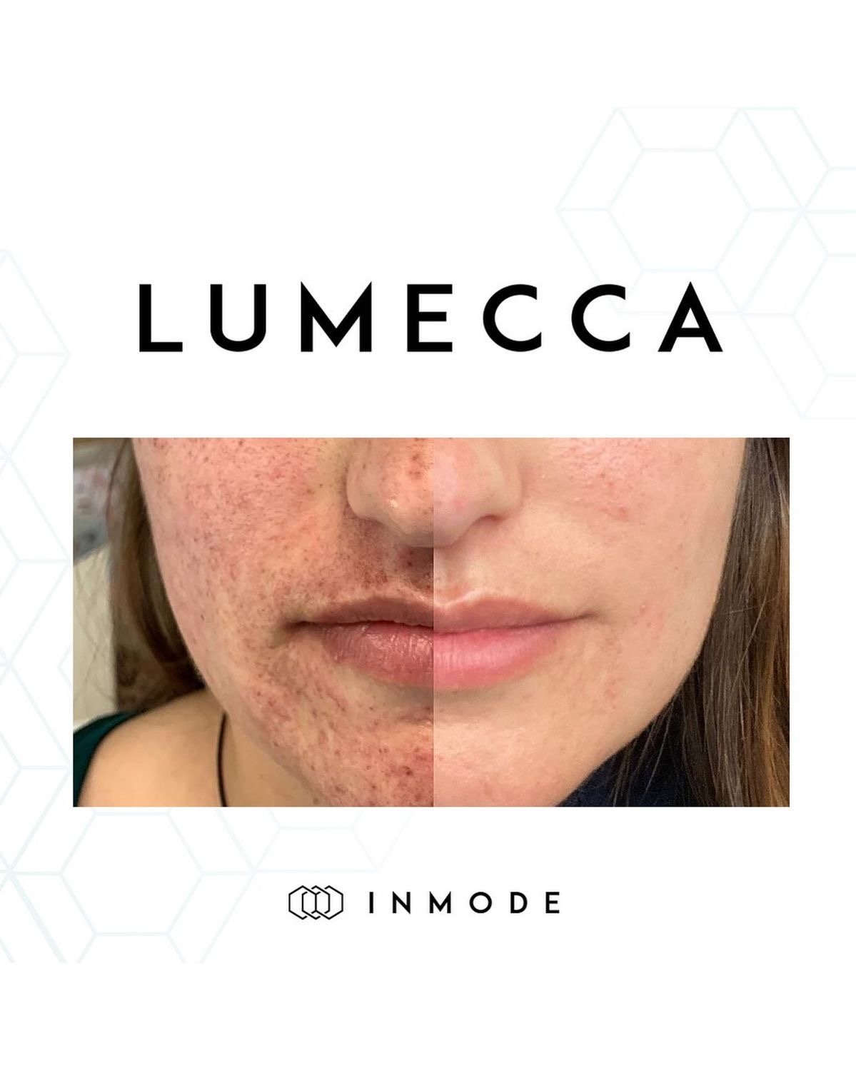 Lumecca IPL pigmentation