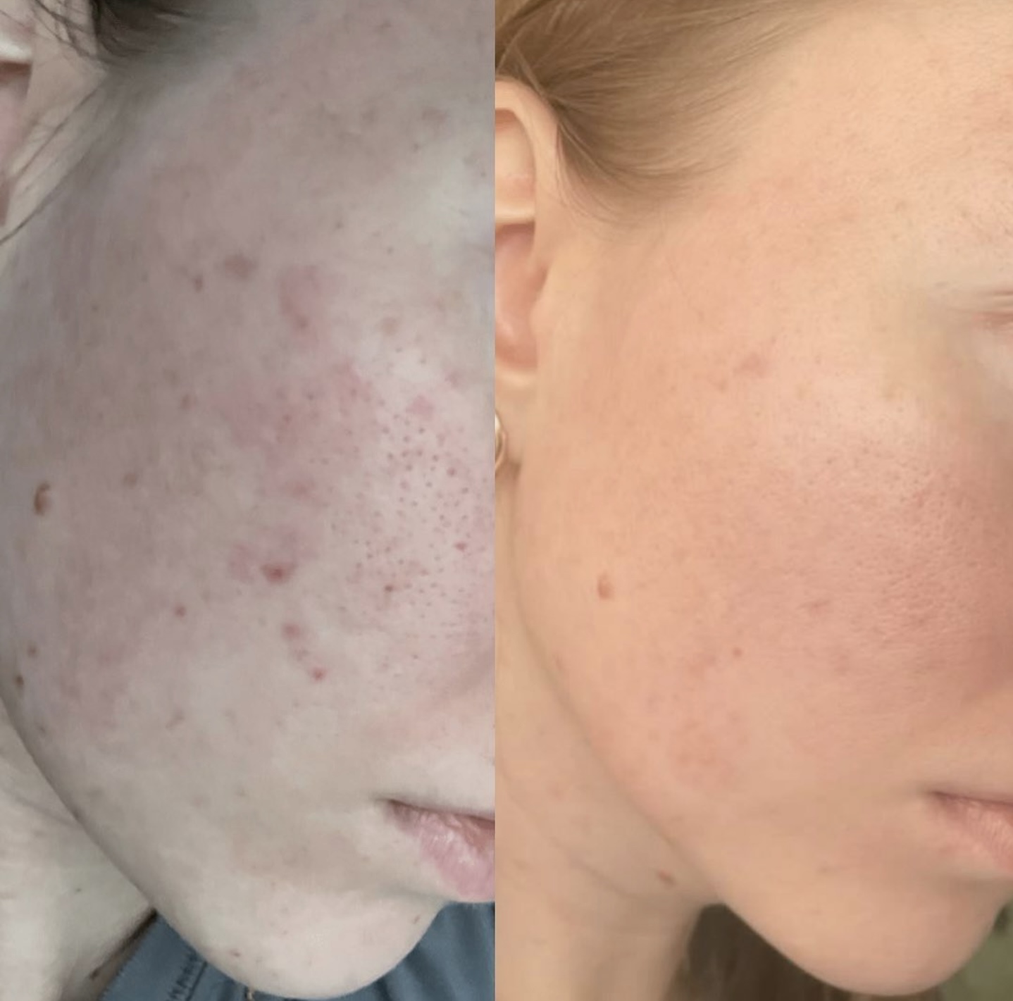 Facial treatment before and after 1