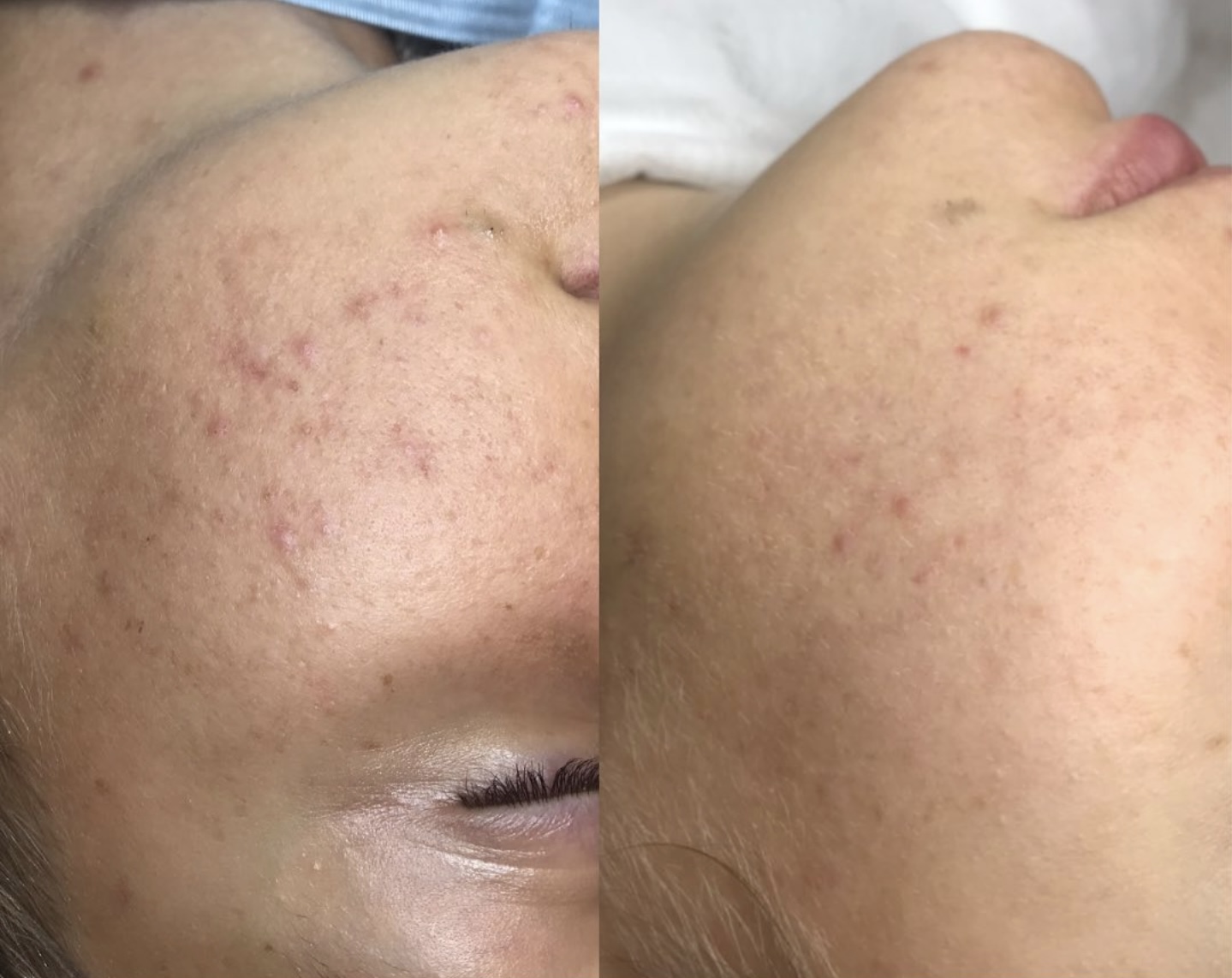 Facial treatment before and after 5