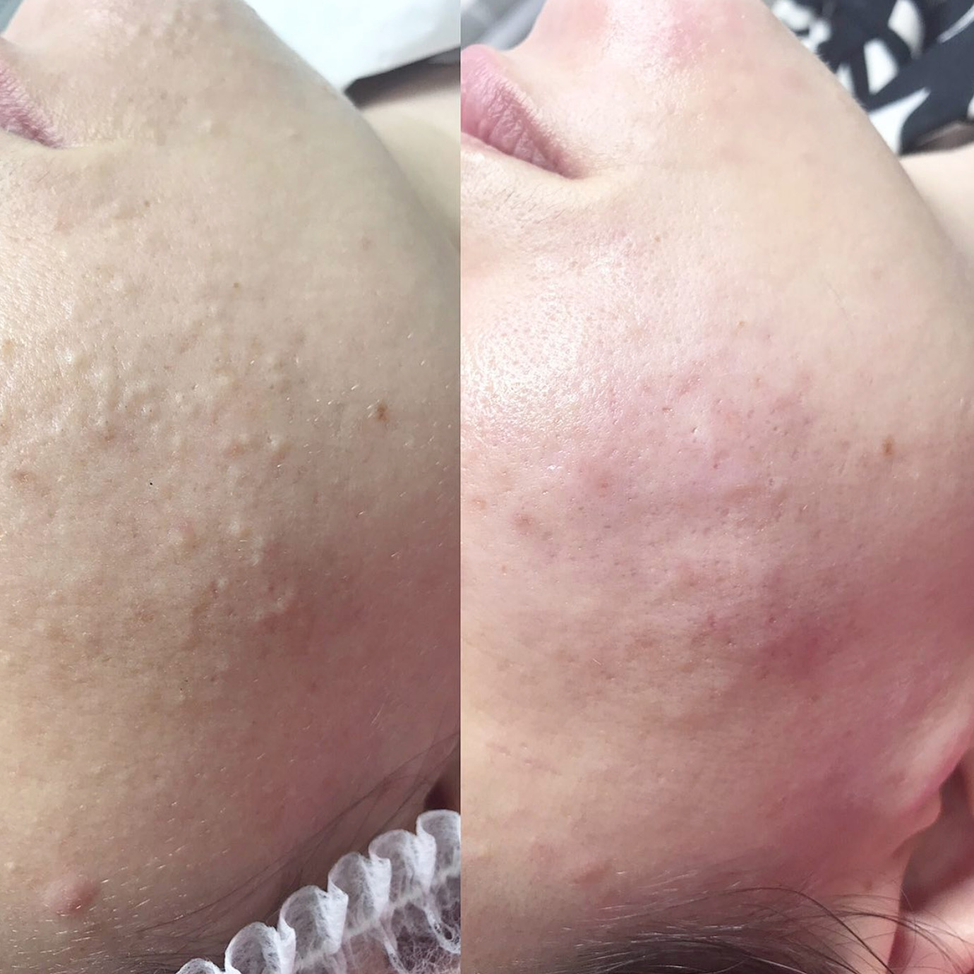 Facial treatment before and after 4