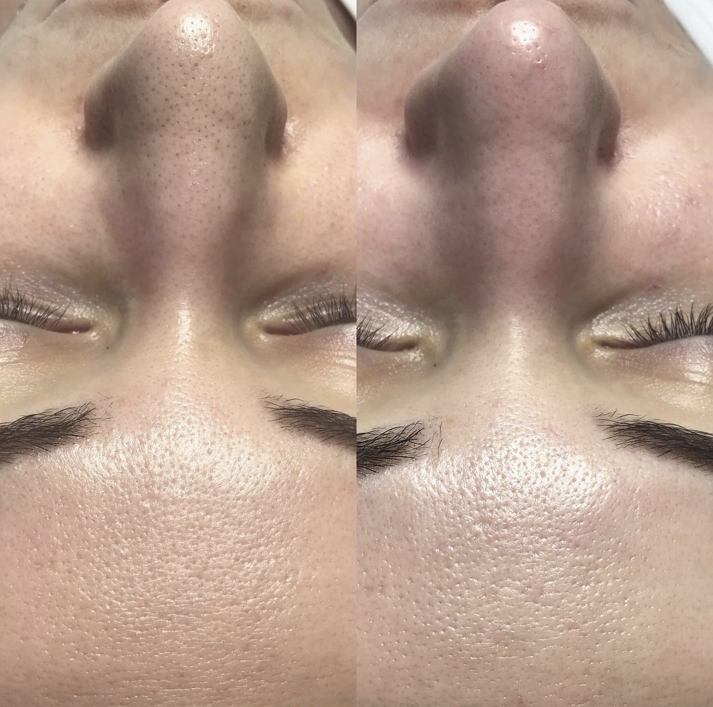Facial treatment before and after 3