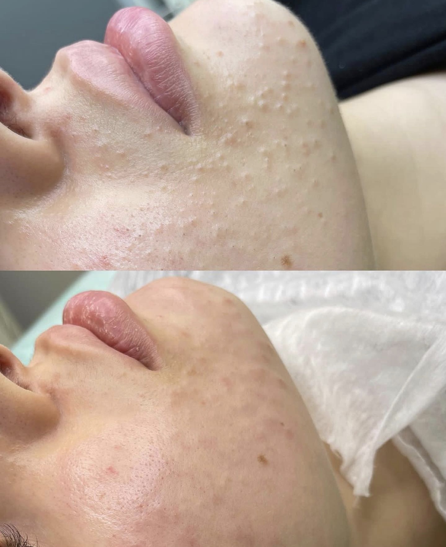 Facial treatment before and after 2